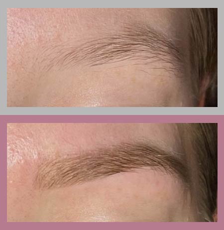Women Before and After Sleekbrow Treatment